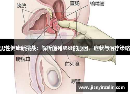 男性健康新挑战：解析前列腺炎的原因、症状与治疗策略